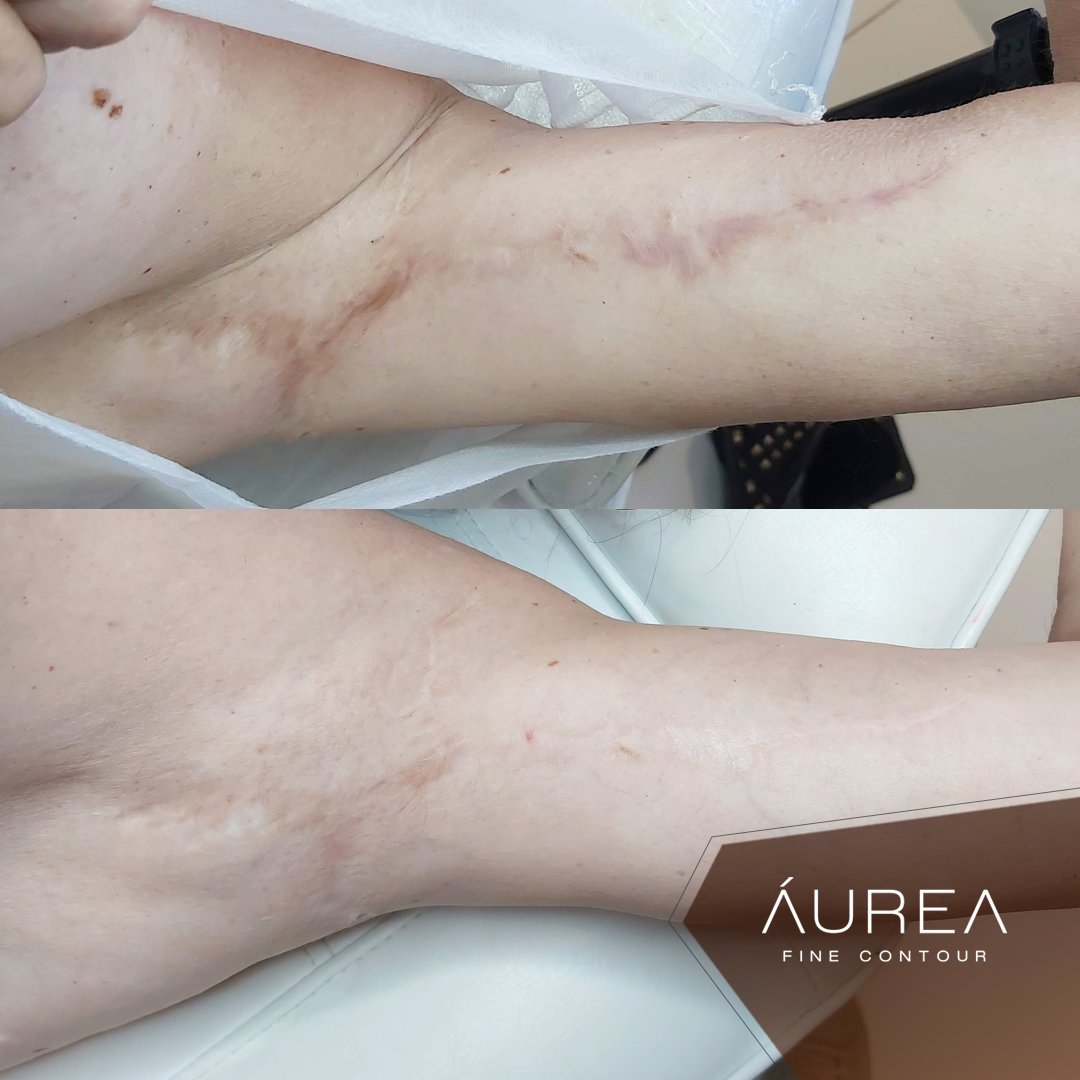 Resultado Áurea Skin — Cicatriz