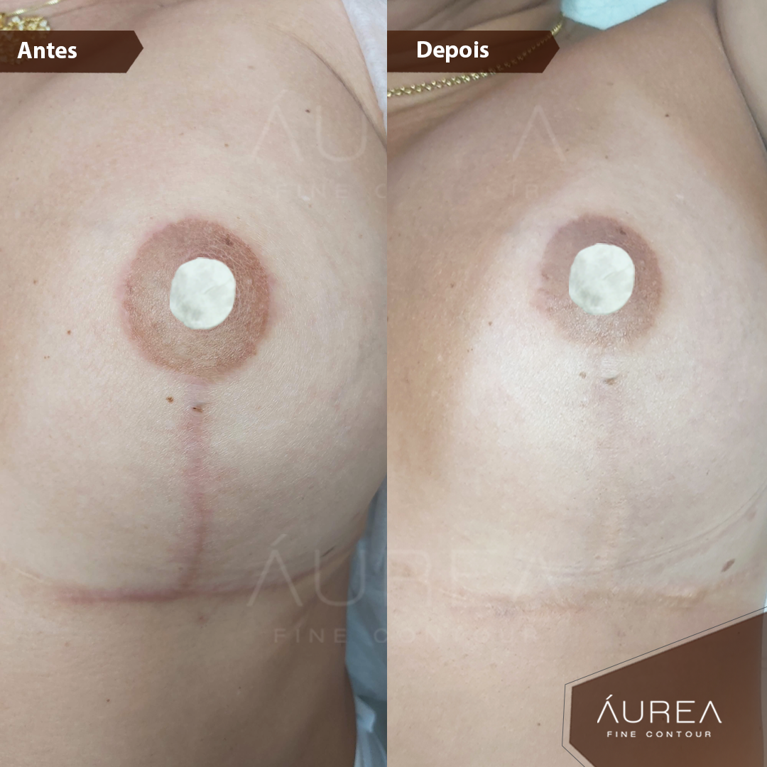 Resultado Camuflagem Reparadora — Áurea Skin Curitiba