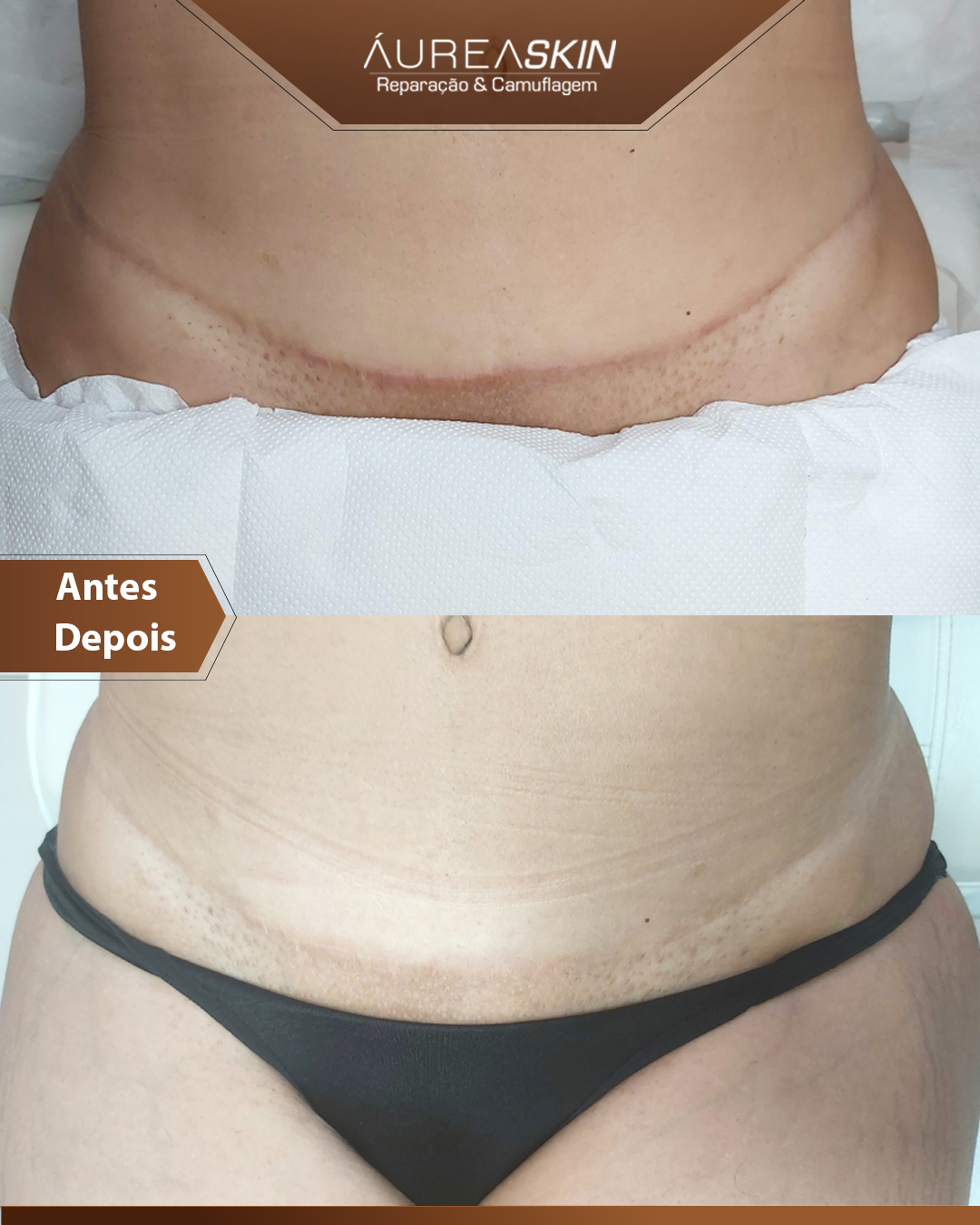 Resultado Camuflagem Reparadora — Áurea Skin Curitiba