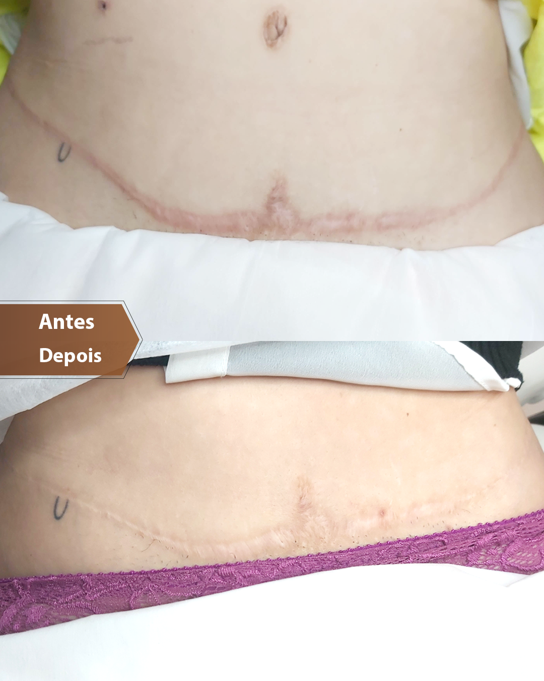 Resultado Camuflagem Reparadora — Áurea Skin Curitiba