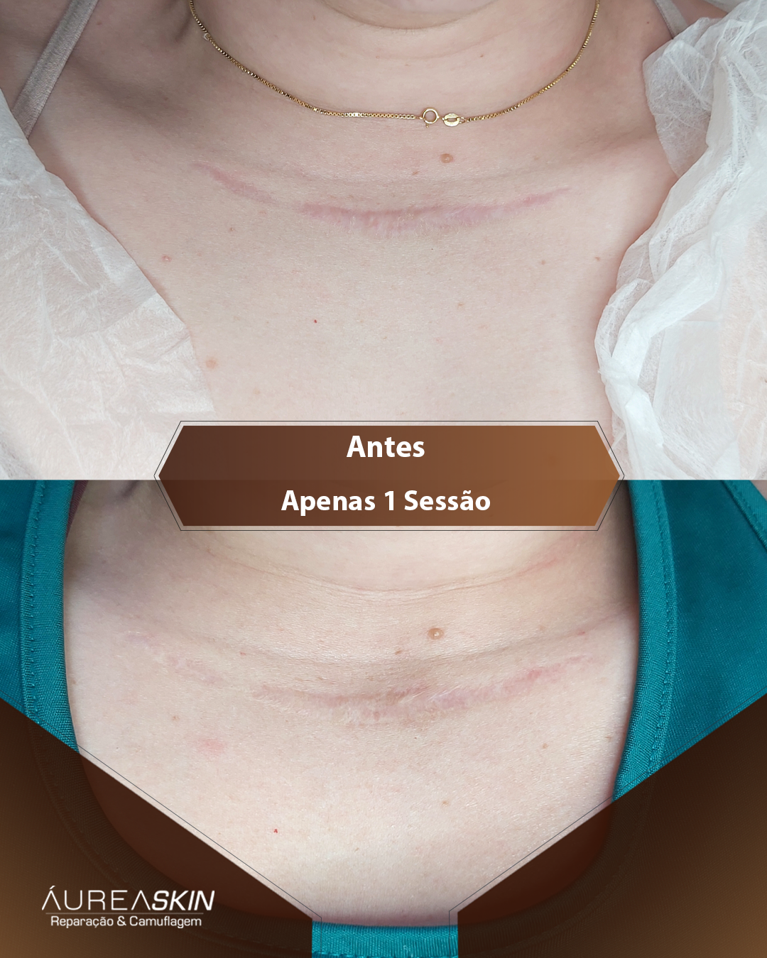 Resultado Camuflagem Reparadora — Áurea Skin Curitiba