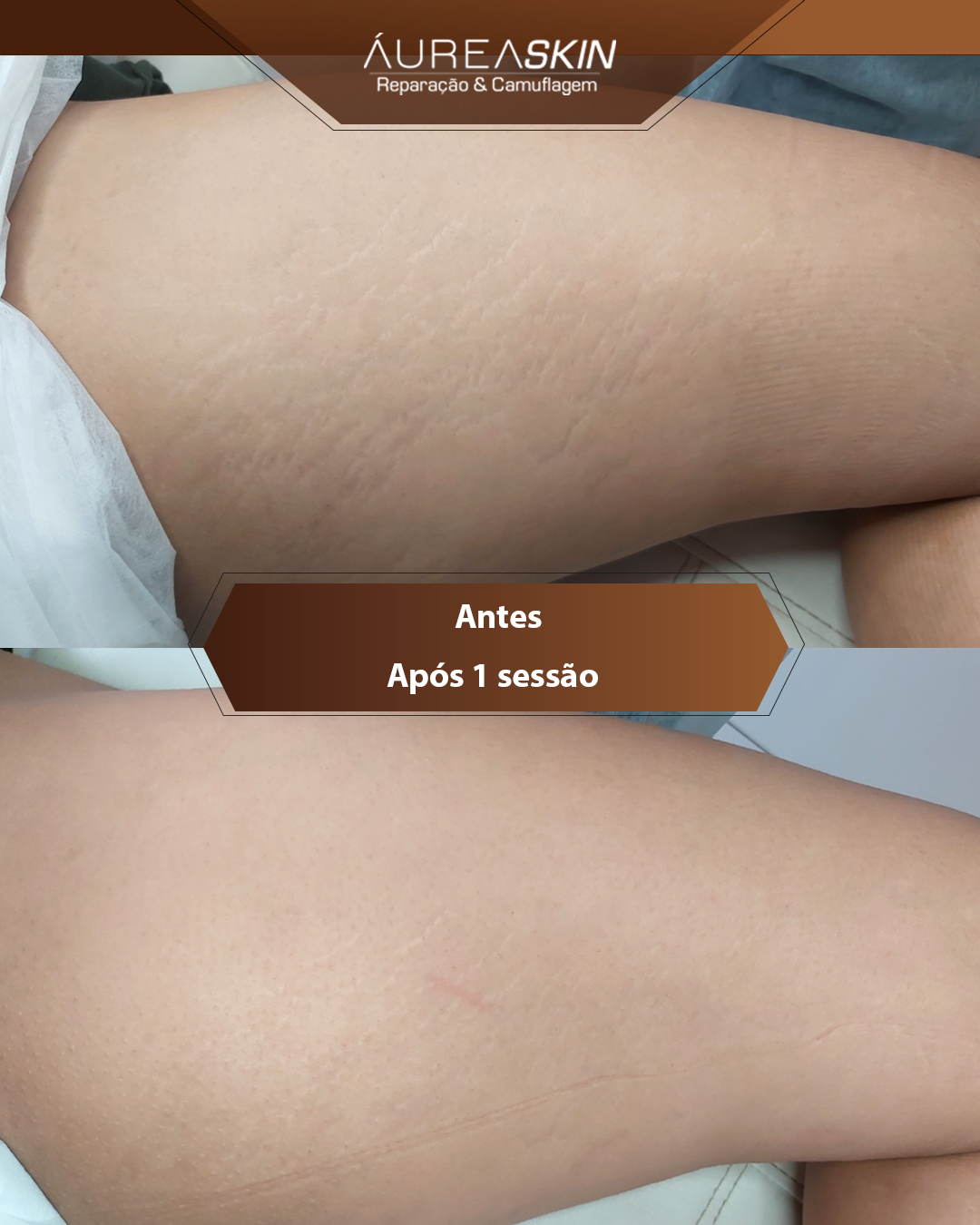 Resultado Camuflagem Reparadora — Áurea Skin Curitiba