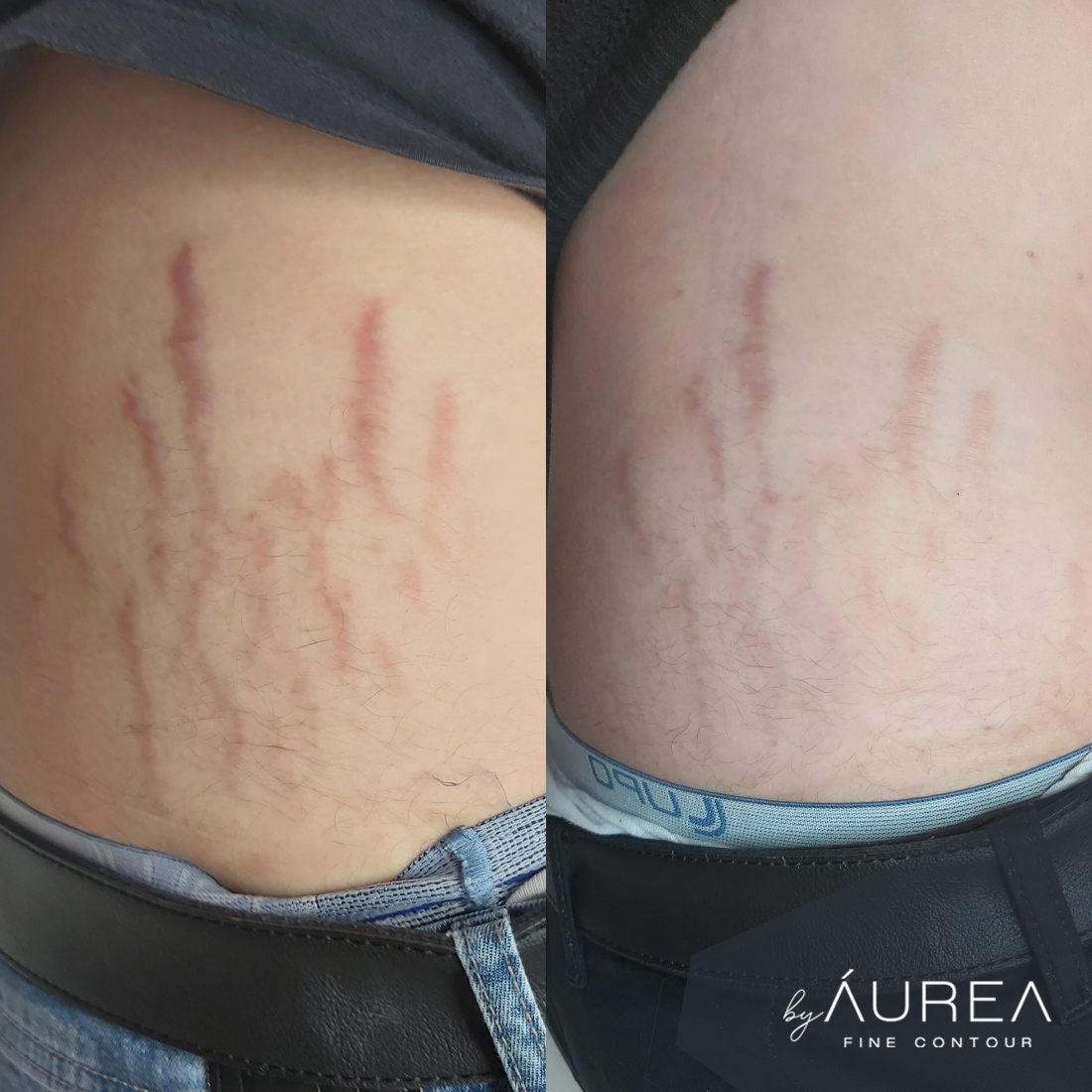 Resultado Camuflagem Reparadora — Áurea Skin Curitiba