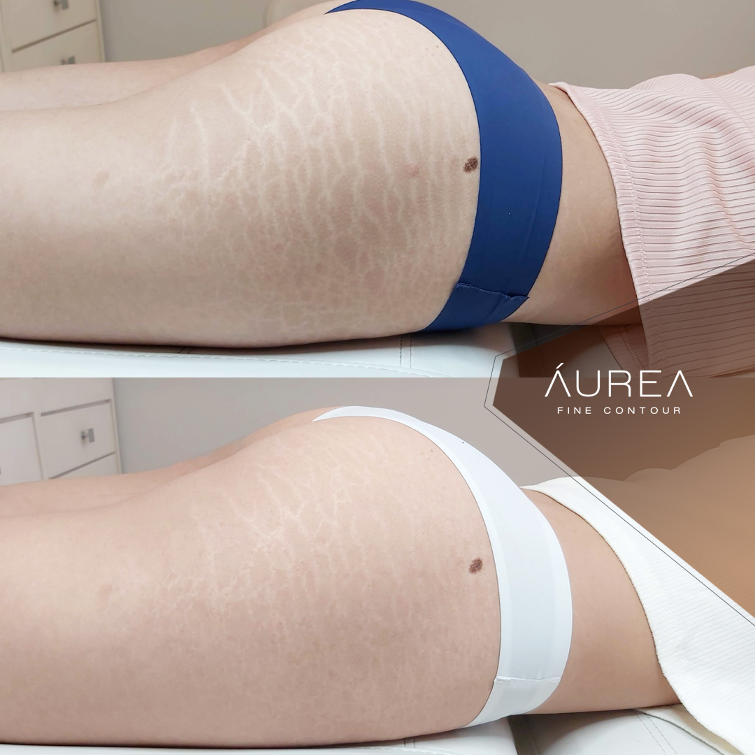 Resultado Camuflagem Reparadora — Áurea Skin Curitiba