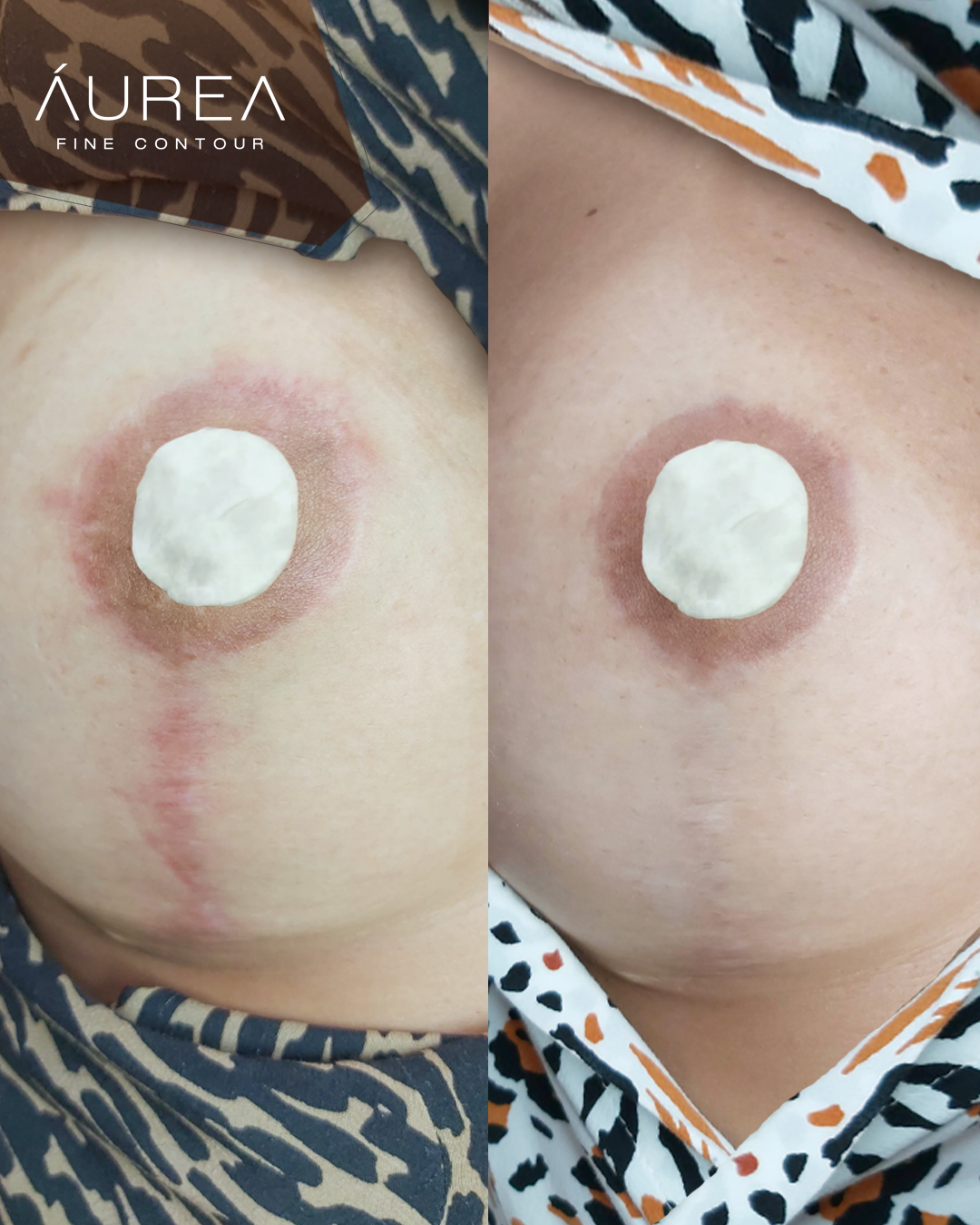 Resultado Camuflagem Reparadora — Áurea Skin Curitiba