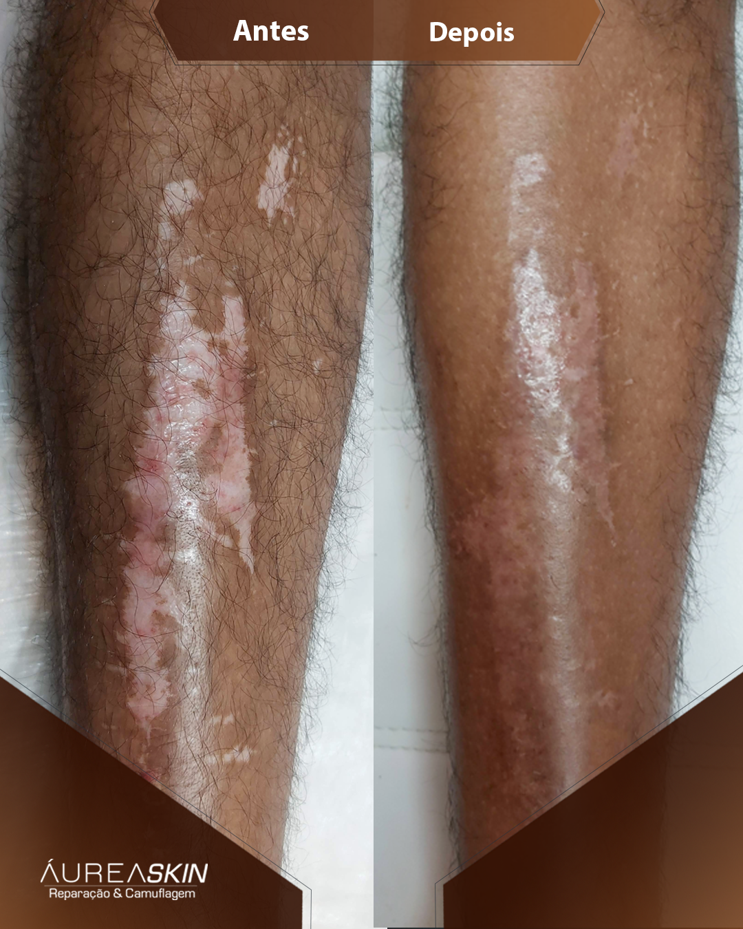 Resultado Camuflagem Reparadora — Áurea Skin Curitiba
