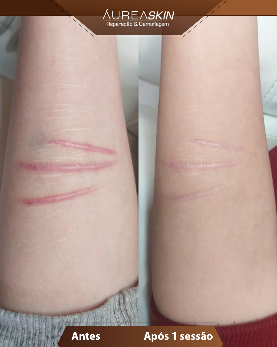 Resultado Camuflagem Reparadora — Áurea Skin Curitiba