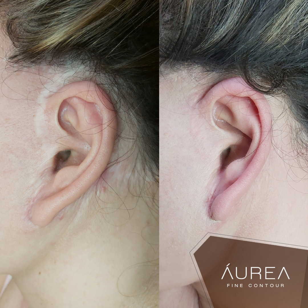 Resultado Camuflagem Reparadora — Áurea Skin Curitiba